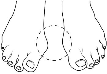 Hallux valgus | Skor För Hallux Valgus? | CinnamonSkor Hallux valgus | Skor För Hallux Valgus? | CinnamonSkor
